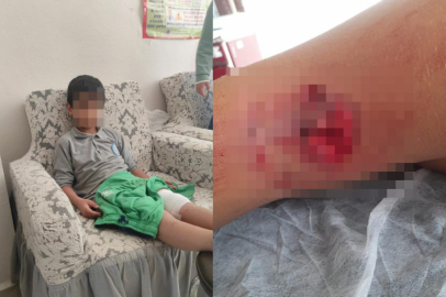 Okula giderken sokak köpeğinin saldırısına uğradı