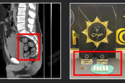 Tomografide şok eden görüntü...Uyuşturucu midesinden çıkarıldı