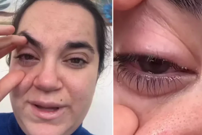 Bulaşık makinesi tableti gözünde patladı, neredeyse kör oluyordu!